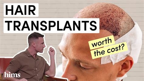 does hair transplant really work quora