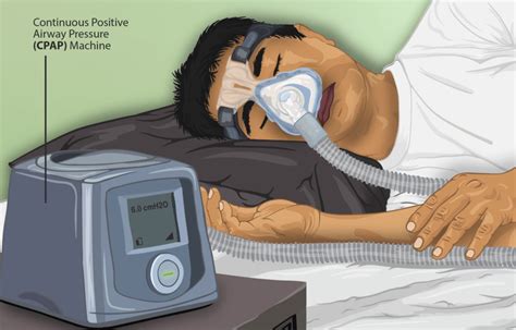 Does Having A Cpap Machine Help With Covid