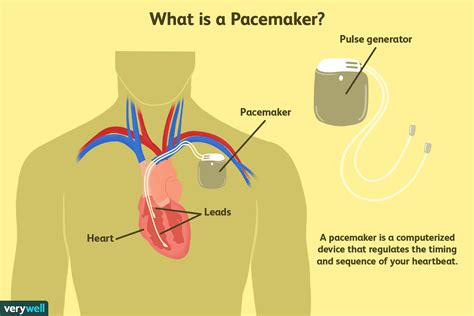 Does Having A Pacemaker Shorten Your Life Expectancy