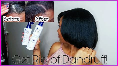 Does Head And Shoulders Help With Dandruff