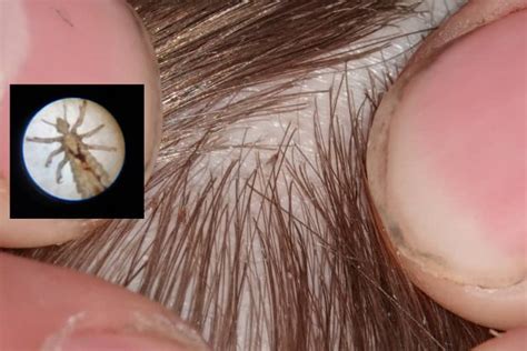 Does Head Lice Leave Scabs