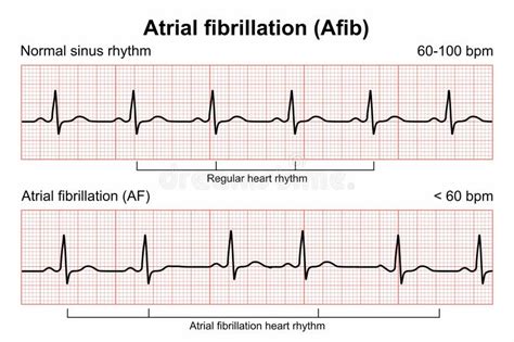 Does Heart Rate Increase With Afib