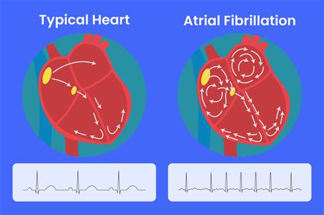 Why Heat Triggers Atrial Fibrillation