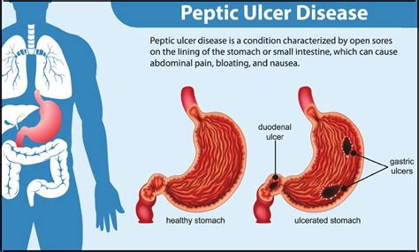 Does Heat Soothe Or Worsen Mouth Ulcers?