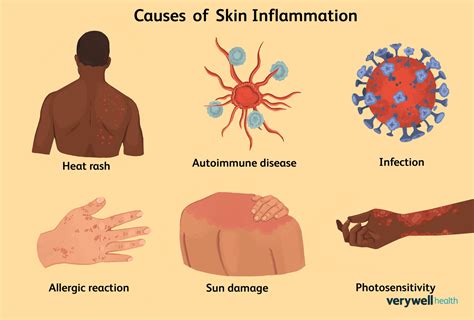 Does Heat Help Inflammation
