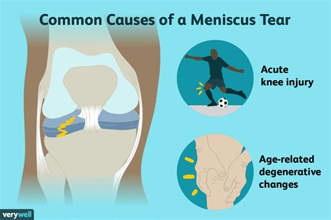 Does Heat Help Meniscus Pain