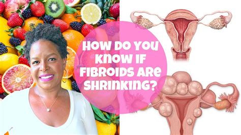 Does Heat Help Shrink Fibroids