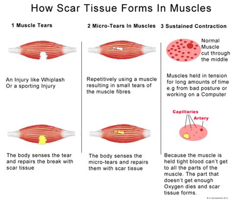 Does Heat Help With Scar Tissue
