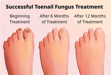 Does Heat Kill Toe Fungus