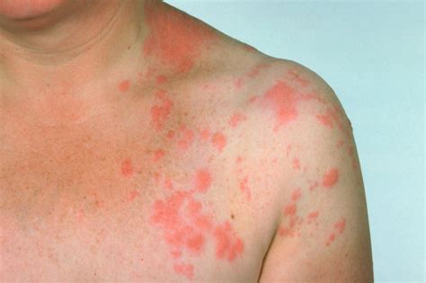 does heat make shingles rash worse