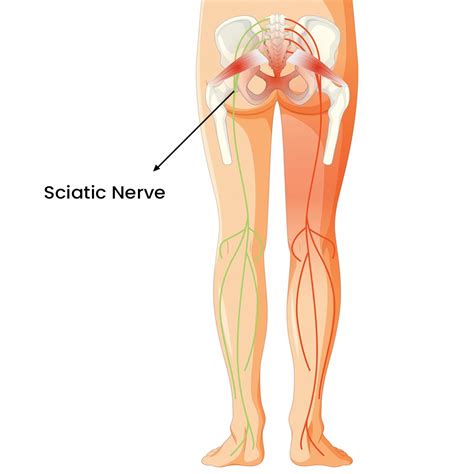 Does Heat Relieve Sciatica