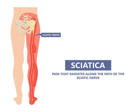 Does Heat Worsen Sciatica