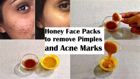 Does Honey Help To Remove Pimple Marks