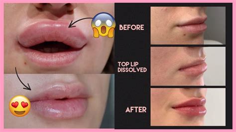 Does Ibuprofen Help With Lip Swelling
