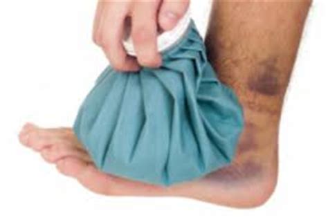 Does Ice Help Heal Bruises Faster