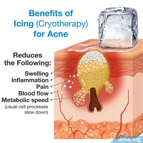 Does Ice Reduce Swelling Acne