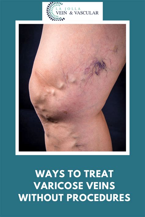 Does Icing Help Varicose Veins