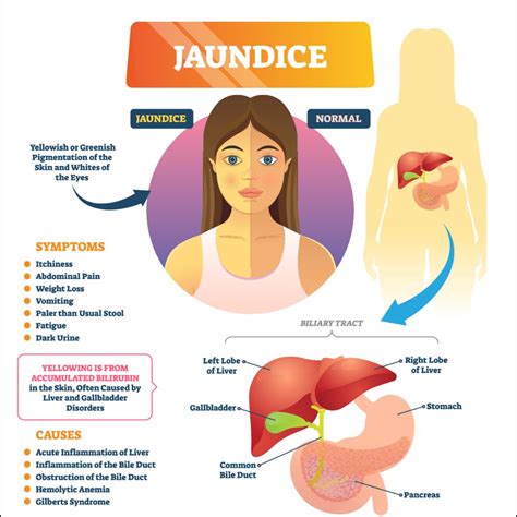 Does Inducing Labor Cause Jaundice