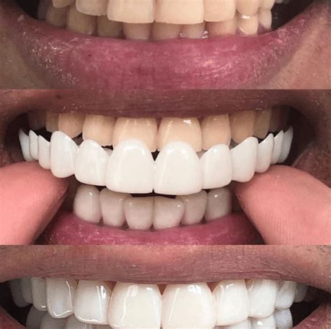 does instant smile teeth work