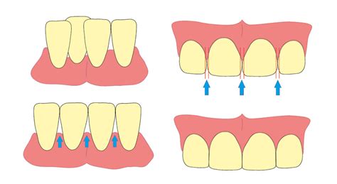 Does Interproximal Reduction Damage Teeth