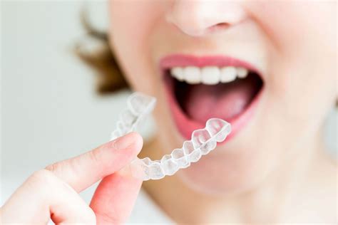 does invisalign braces really work
