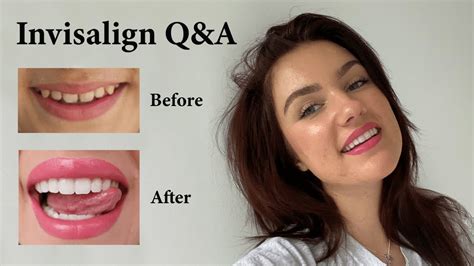 does invisalign really work