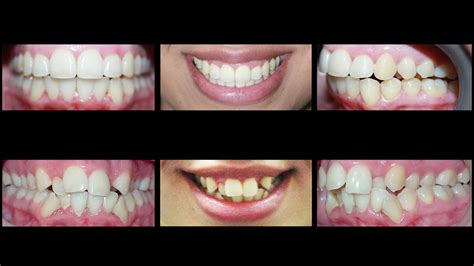 does invisalign work for crooked and crowded teeth