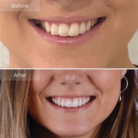 does invisalign work for crowded teeth