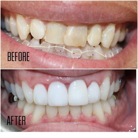 does invisalign work really crooked teeth