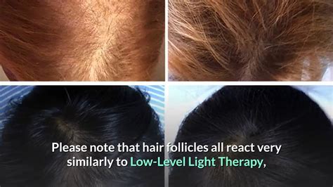 does irestore cause hair loss
