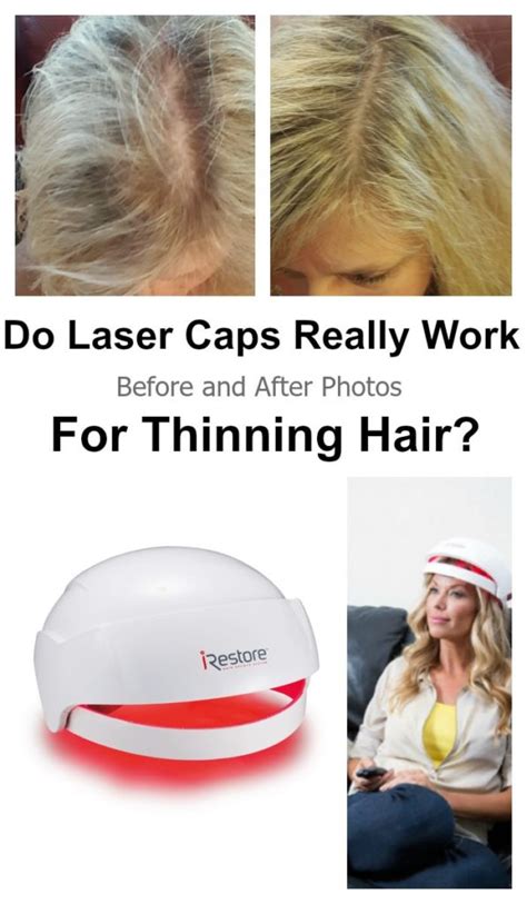 does irestore hair laser work