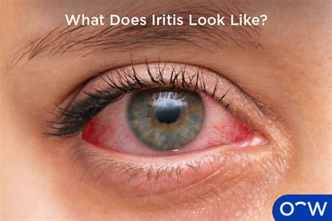 does iritis come and go