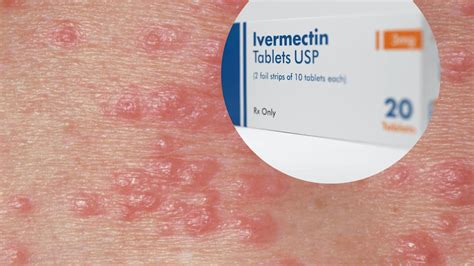 does ivermectin cream treat scabies