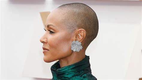 does jada smith really have alopecia