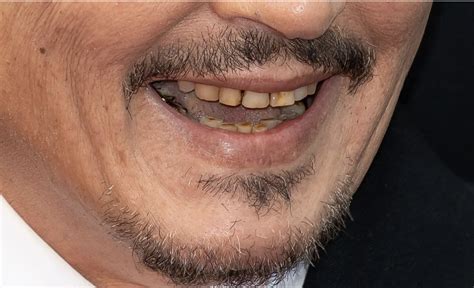 does johnny depp have rotten teeth
