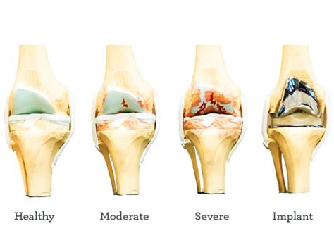 Does Joint Replacement Help Arthritis