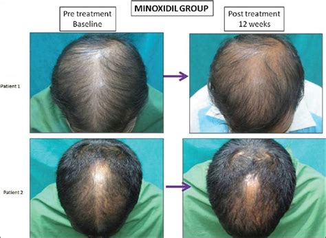 Unlocking Hair Regrowth: Unveiling the Efficacy of Minoxidil
