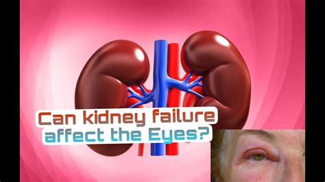 Does Kidney Failure Affect Your Vision