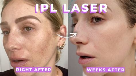 Does Laser Ipl Hurt