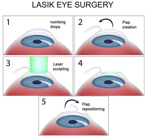 does lasik eye surgery fix astigmatism
