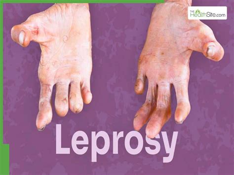 Does Leprosy Hurt