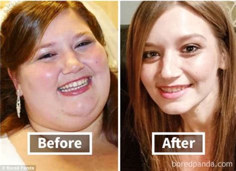 Does Losing Weight Make Your Dimples Deeper