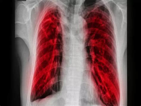 does lung infiltrate mean cancer