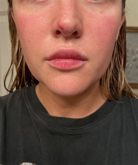 does malar rash come and go