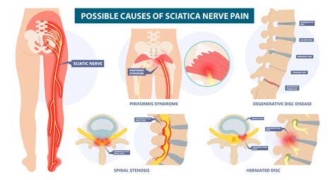Does Manipulation Help Sciatica