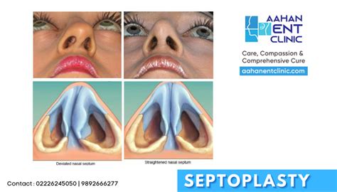 does medi cal cover septoplasty