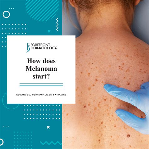 does melanoma always start with a mole