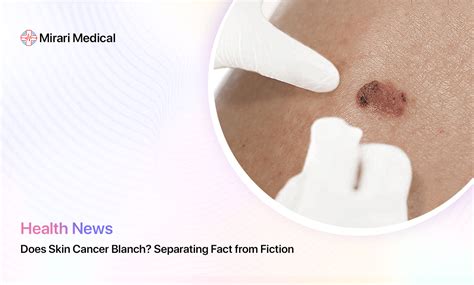 does melanoma blanch