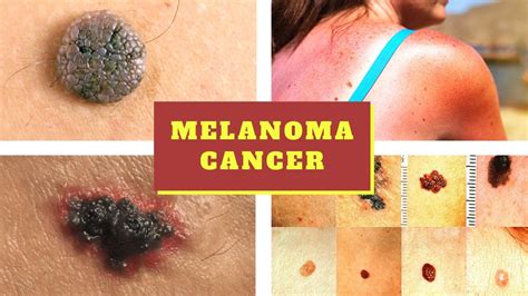 does melanoma make you tired