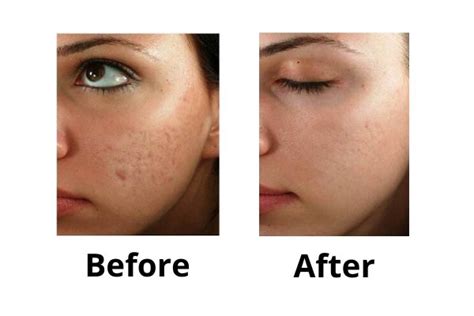 Does Micro Needling Work For Spider Veins